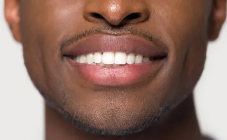 Dental Crowns